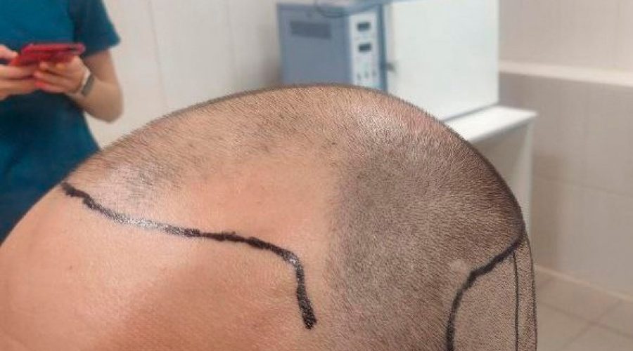 Пересадка волос и занятия спортом: что важно знать.